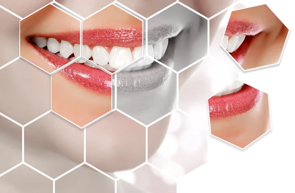 Composite Bonding treatment