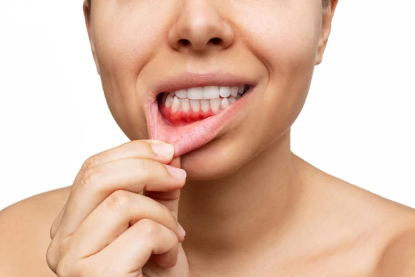 What Causes Gum Recession