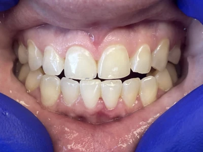 esthetic crown lengthening after