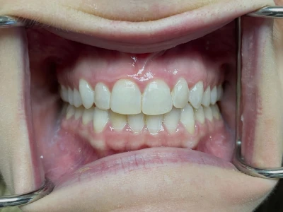 invisalign patient 1 after