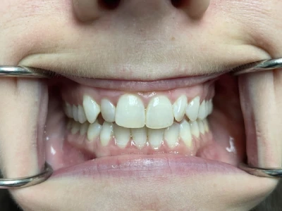 invisalign patient 1 before