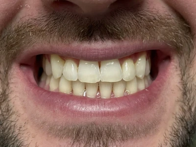 invisalign patient 2 after