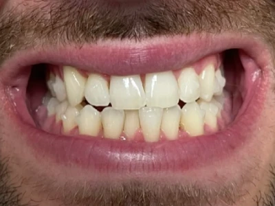 invisalign patient 2 before