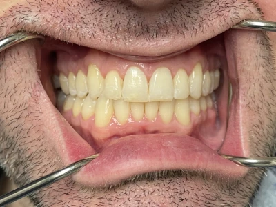 invisalign patient 3 after