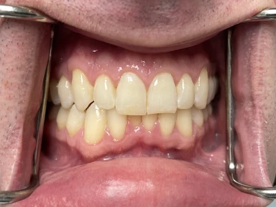 invisalign patient 3 before