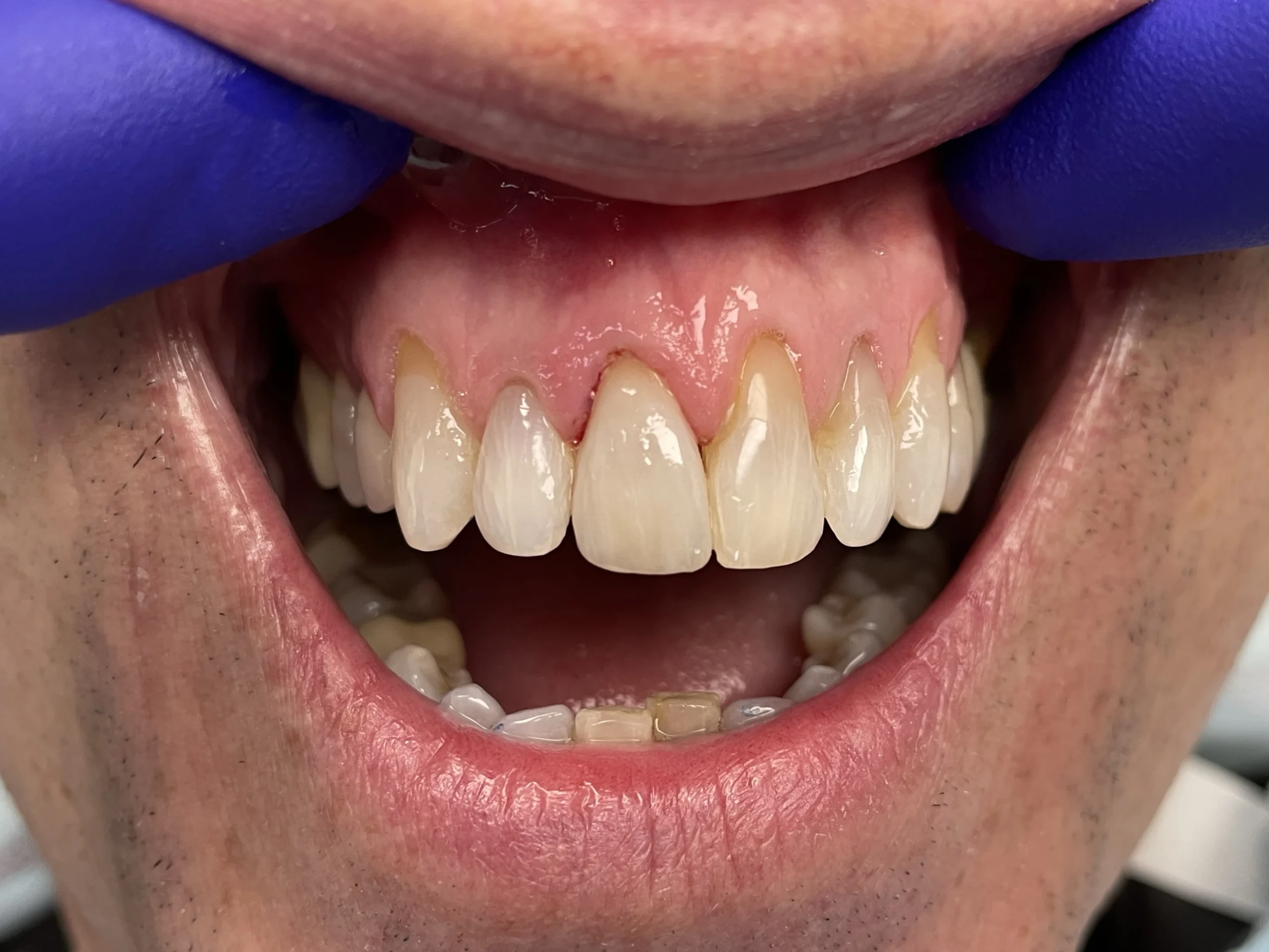 single tooth restoration after