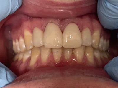veneers patient 1 after