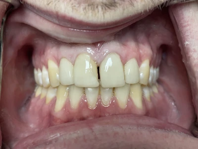 veneers patient 1 before