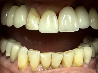 single tooth bonding after