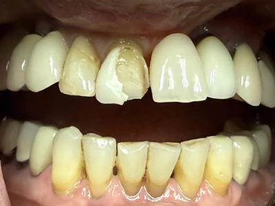 single tooth bonding before